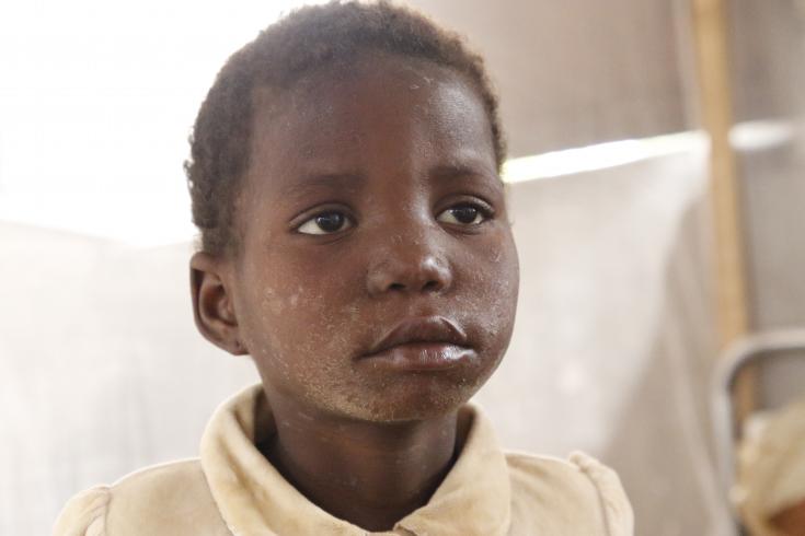 Niño diagnosticado de sarampión en RDC. 
