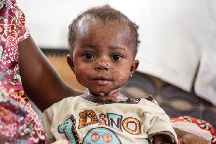 La madre de Phemba, de 11 meses, llegó al centro de tratamiento de sarampión con sus dos hijas gemelas hace 4 días.